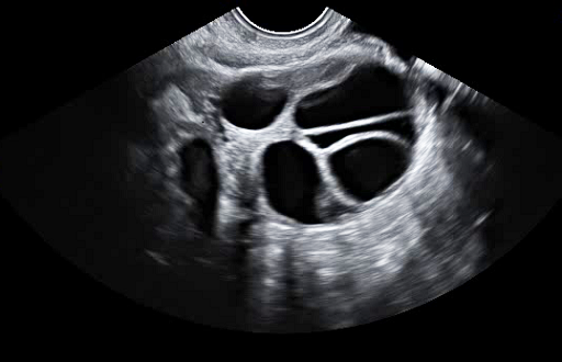 Image échographique d'un ovaire stimulé