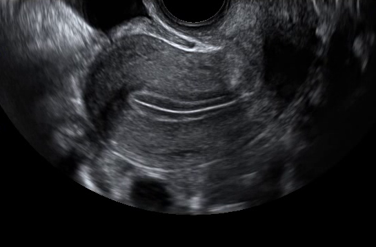 Image échographique d'un utérus